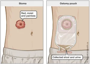 illustration of a stoma and ostomy pouch attached