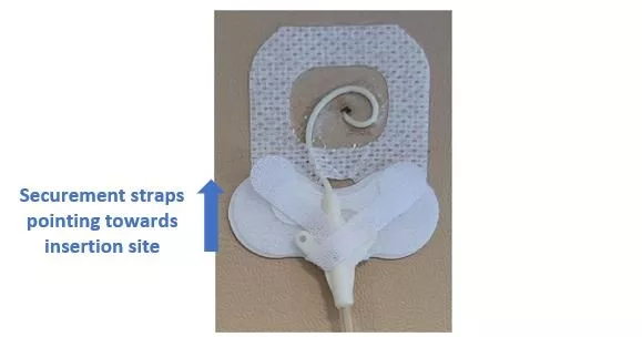 application of securement device