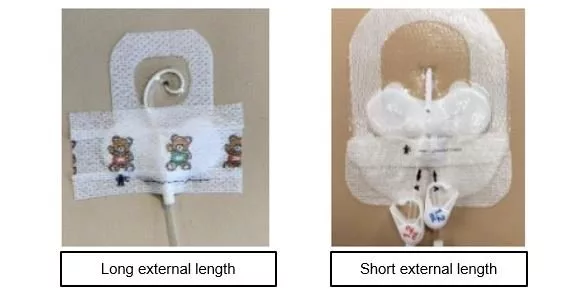 variations in application of securement device